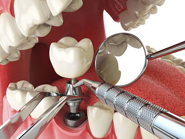 Best Emergency Dentist for Knocked-Out Tooth in Gastonia, NC